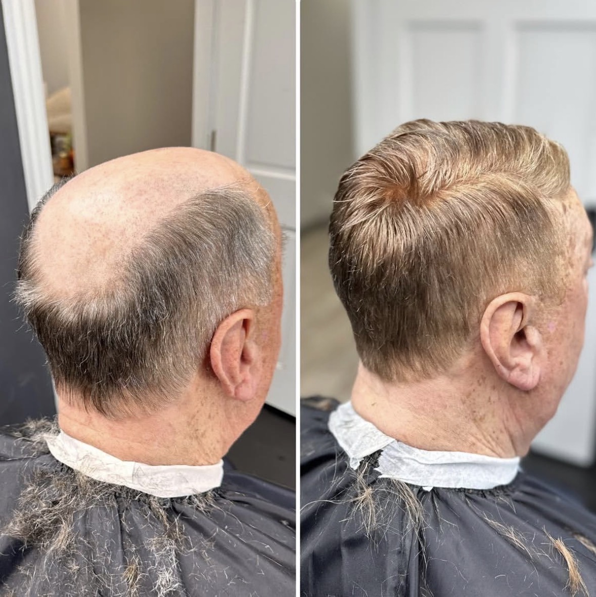 Veteran cranial prosthesis transformation — Natural Hairline Restoration