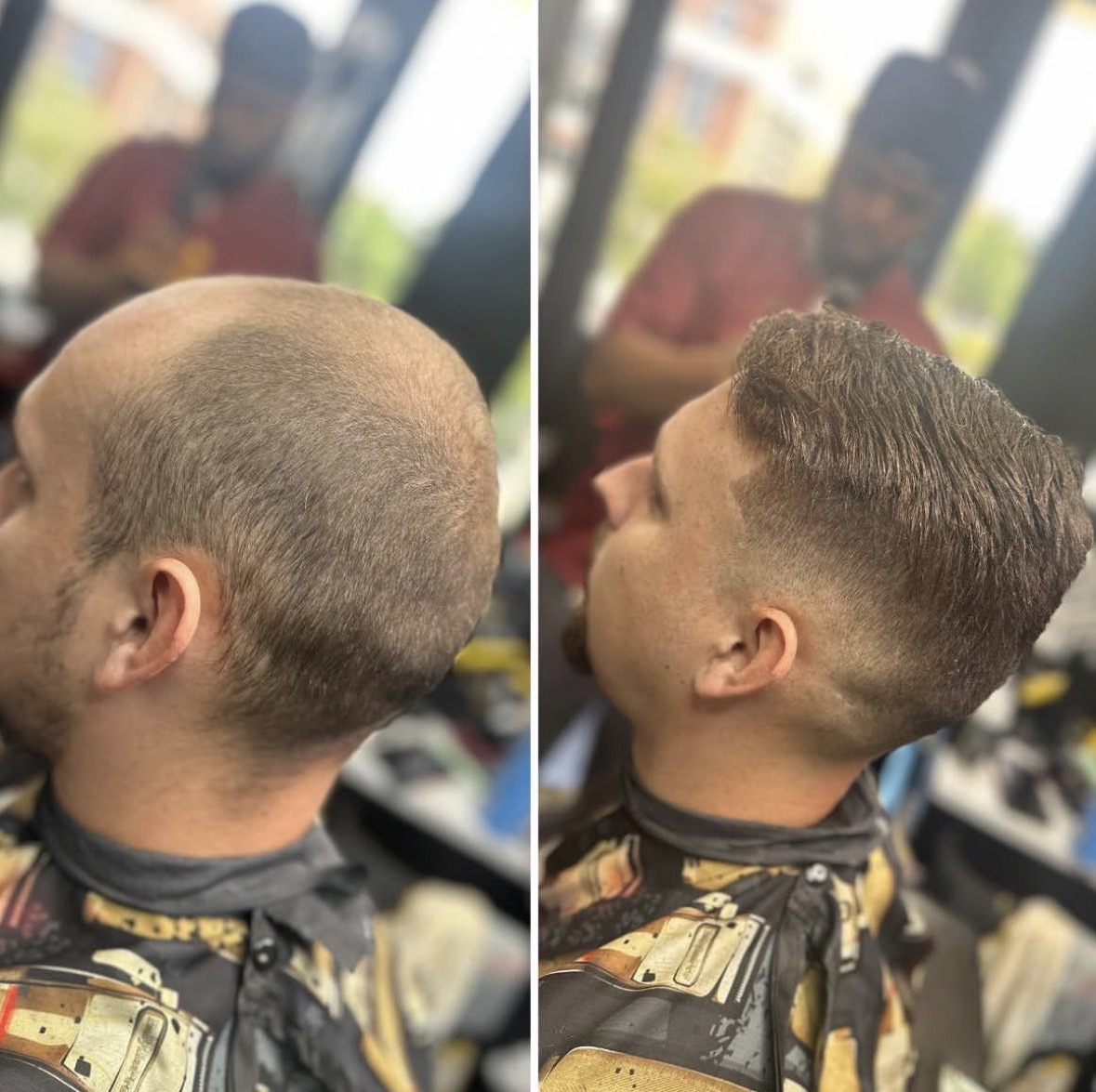 Veteran cranial prosthesis transformation — 4–6 Month Custom Unit