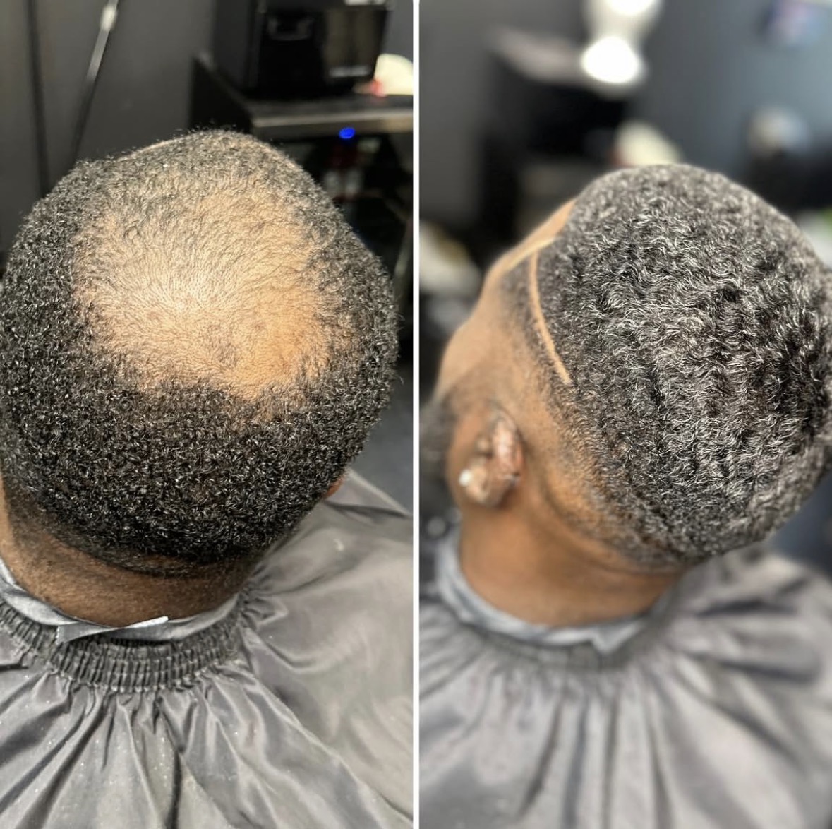 Veteran cranial prosthesis transformation — Seamless Density Match